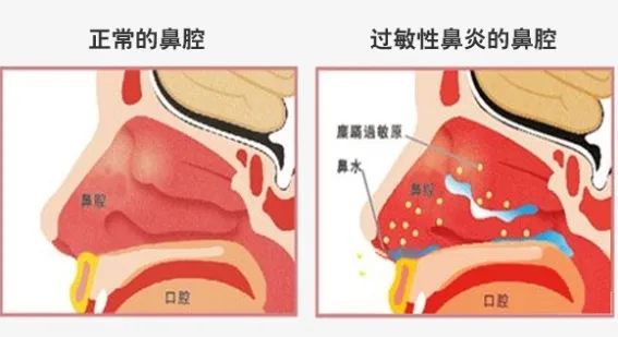 【秋冬鼻炎爆品】鼻抗敏凝胶&喷剂招商/OEM代工