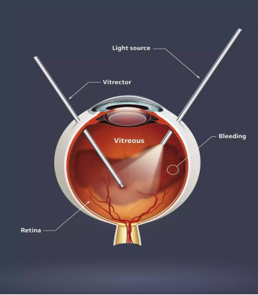 病例分享|突破光明禁区：广州中医药大学金沙洲医院眼科中心首例微创玻璃体视网膜手术