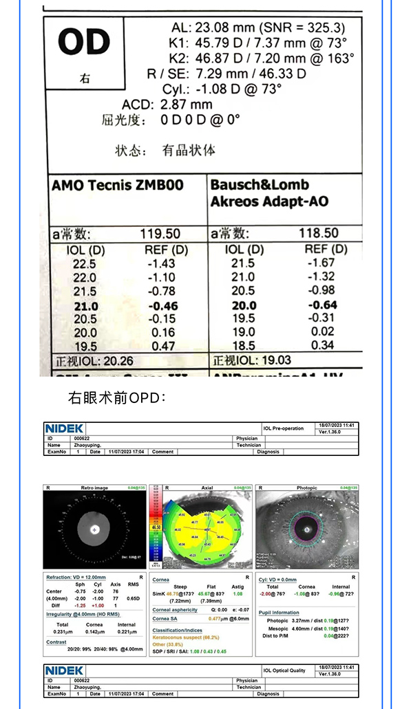 视网膜色素变性与多焦点人工晶状体
