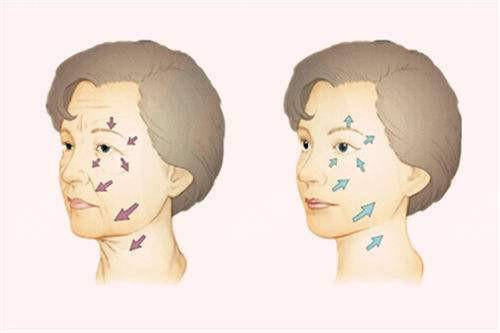 面部拉皮除皱为什么关键在筋膜层？