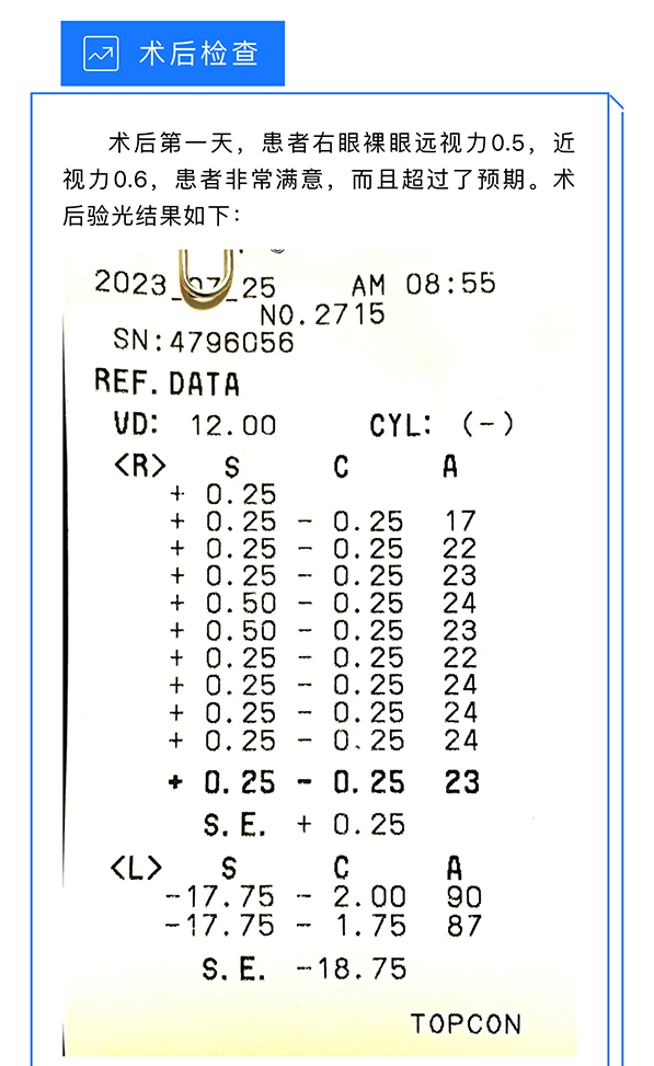 【OPD-Scan III病例分享-黄斑裂孔术后与多焦点人工晶状体