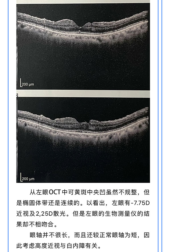 【OPD-Scan III病例分享-黄斑裂孔术后与多焦点人工晶状体
