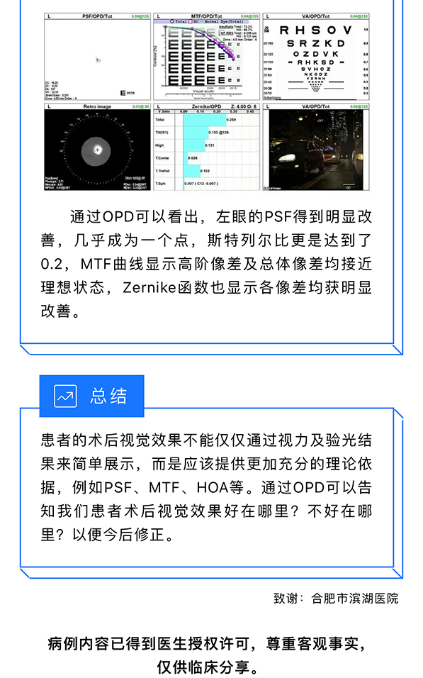 超高度近视与多焦点人工晶状体