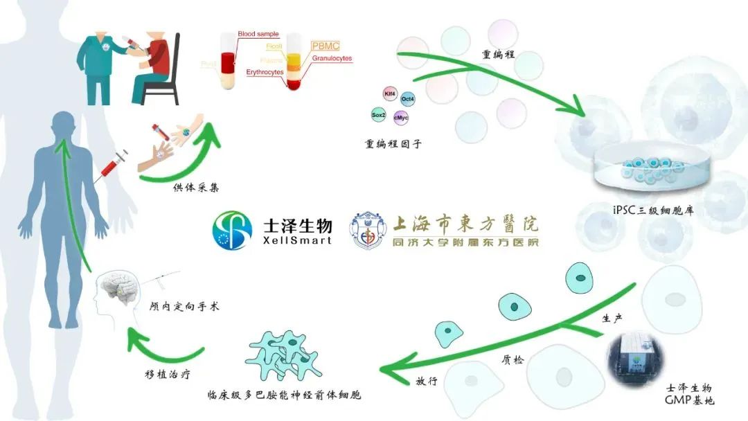 士泽生物iPSC衍生细胞治疗帕金森病获批国家级备案临床研究 | 项目进展