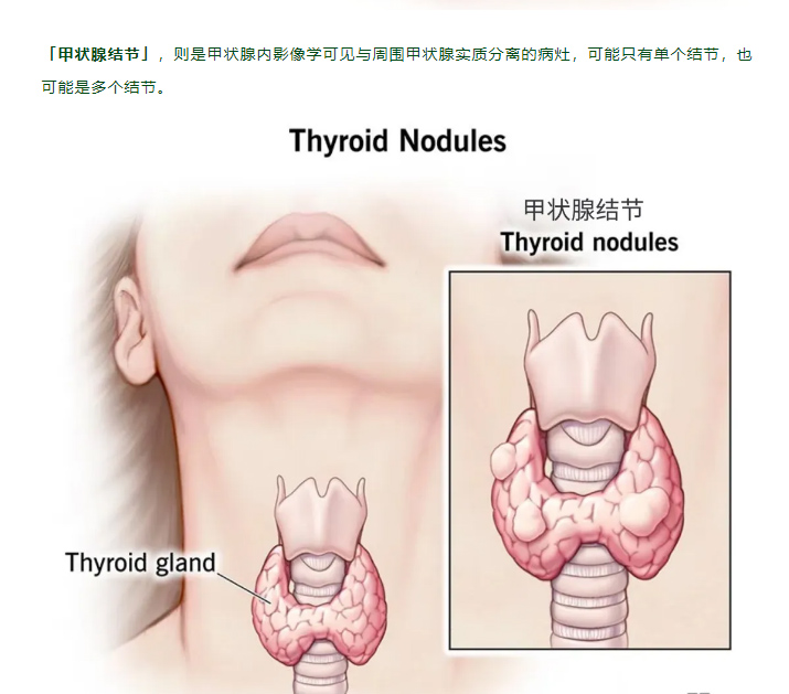 体检查出甲状腺结节，会不会变成癌？