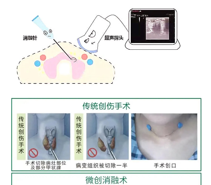 体检查出甲状腺结节，会不会变成癌？