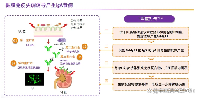 布地奈德缓释胶囊(Nefecon)在IgA肾病的应用