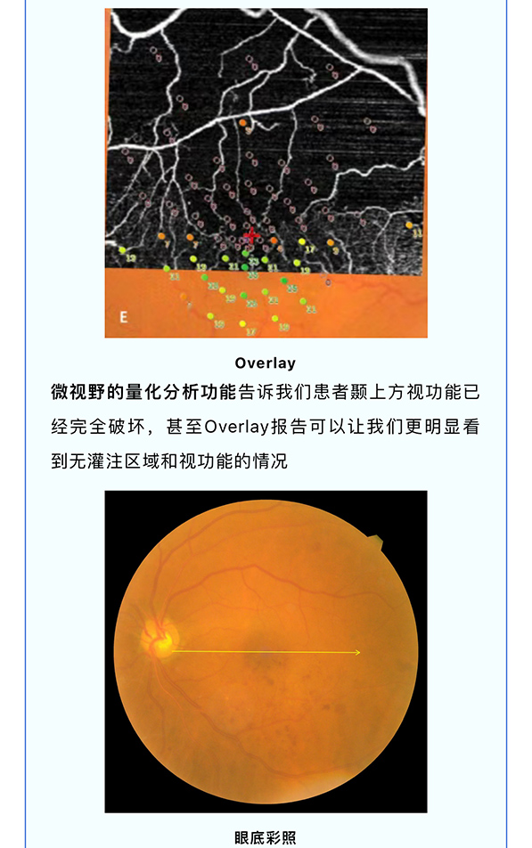 『量化黄斑视功能·从诊到治』——激光治疗的“指明灯”