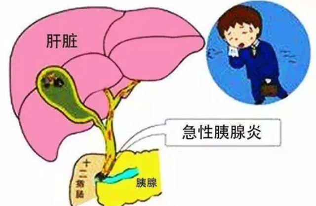 大众科普|来势汹汹的急性胰腺炎，您了解吗？