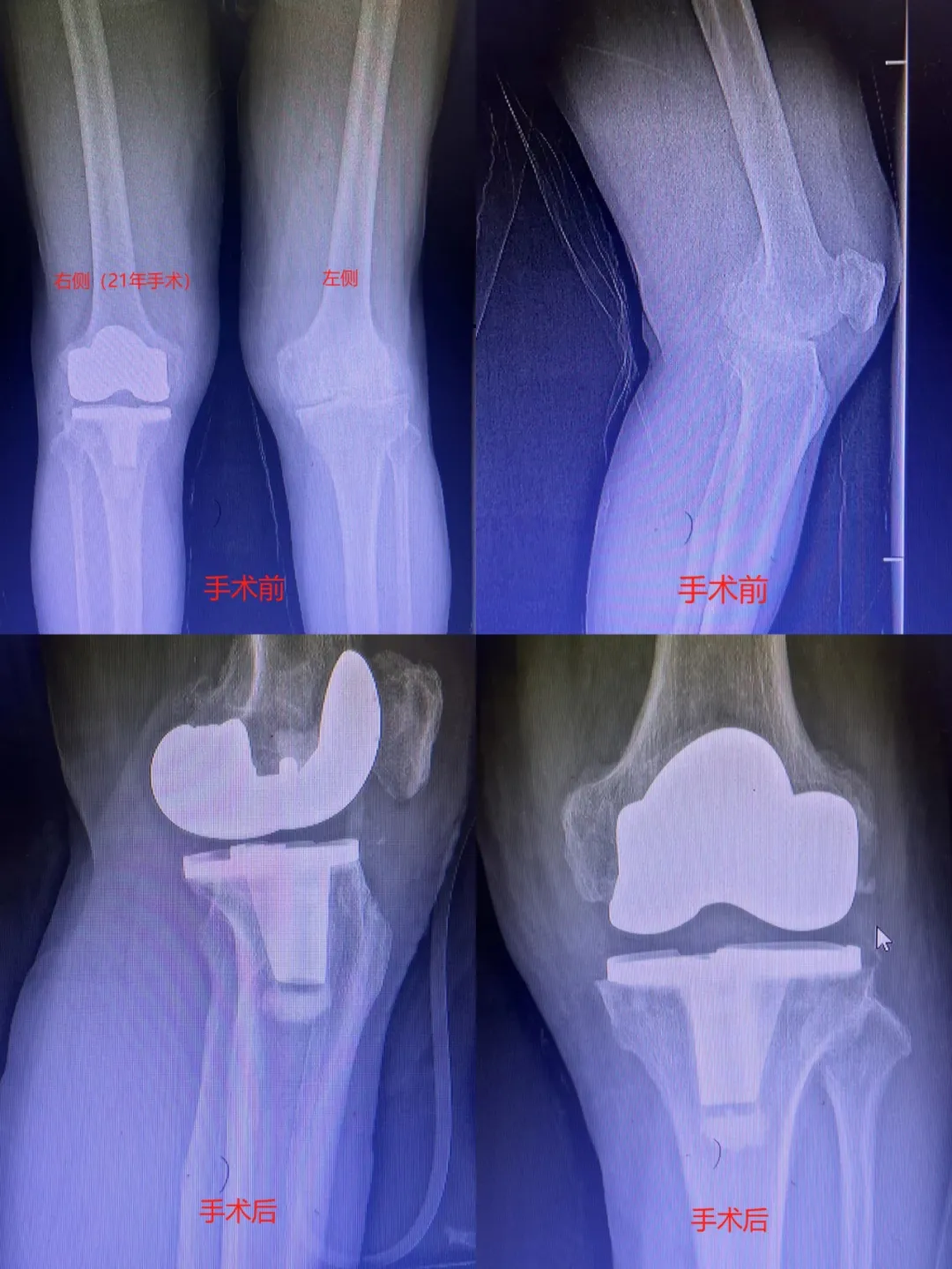 病例分享|膝关节置换术，一天重获新“膝”望