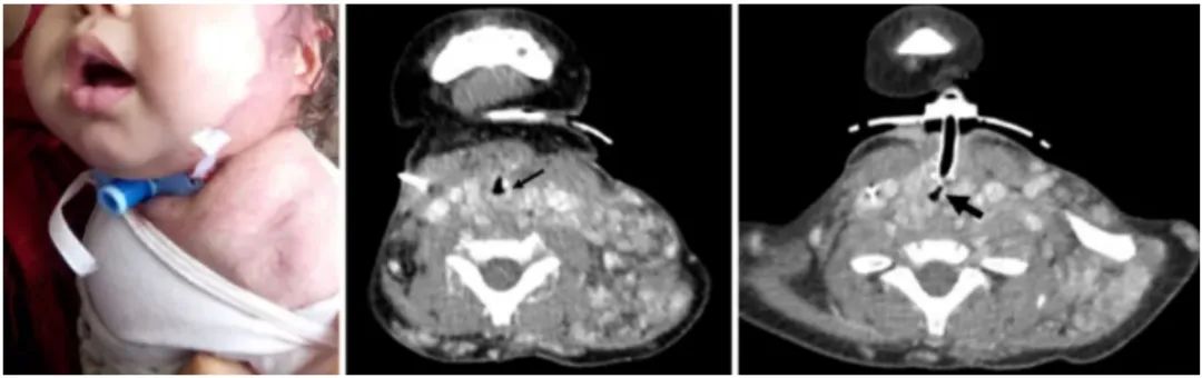 Case Study | Importance of immunoassay for rapamycin