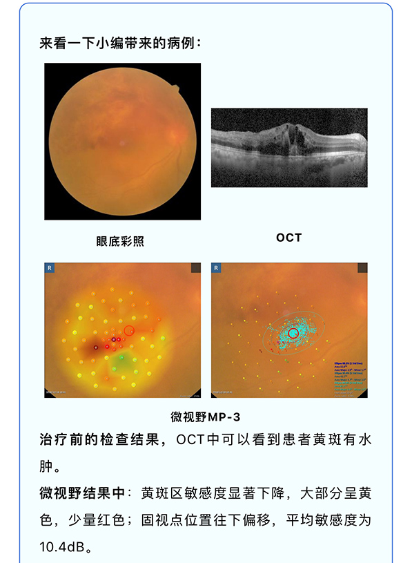 『量化黄斑视功能·从诊到治』— 微视野才是药物治疗的“金标准”