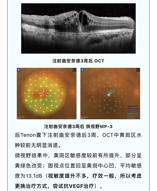 『量化黄斑视功能·从诊到治』— 微视野才是药物治疗的“金标准”