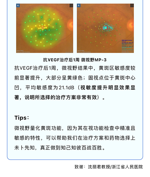 『量化黄斑视功能·从诊到治』— 微视野才是药物治疗的“金标准”