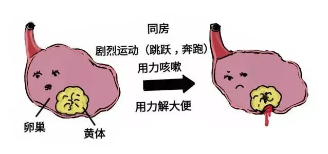 大众科普|带你走进卵巢黄体破裂的世界