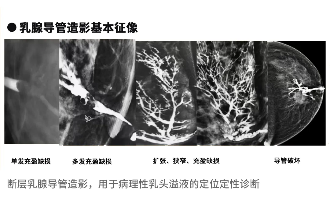 大众科普|守护乳腺健康，了解乳腺X线断层摄影