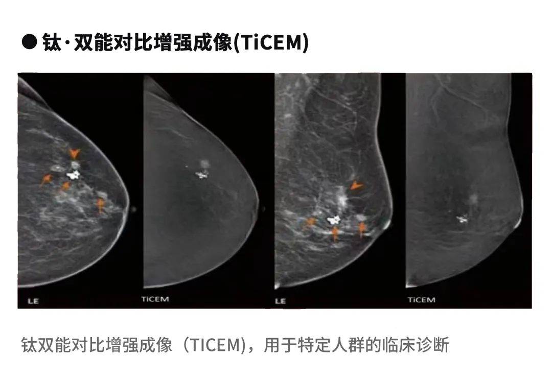 大众科普|守护乳腺健康，了解乳腺X线断层摄影