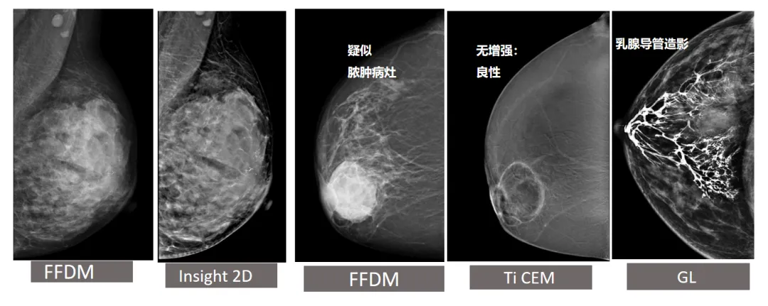 大众科普|守护乳腺健康，了解乳腺X线断层摄影