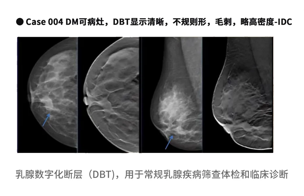 大众科普|守护乳腺健康，了解乳腺X线断层摄影