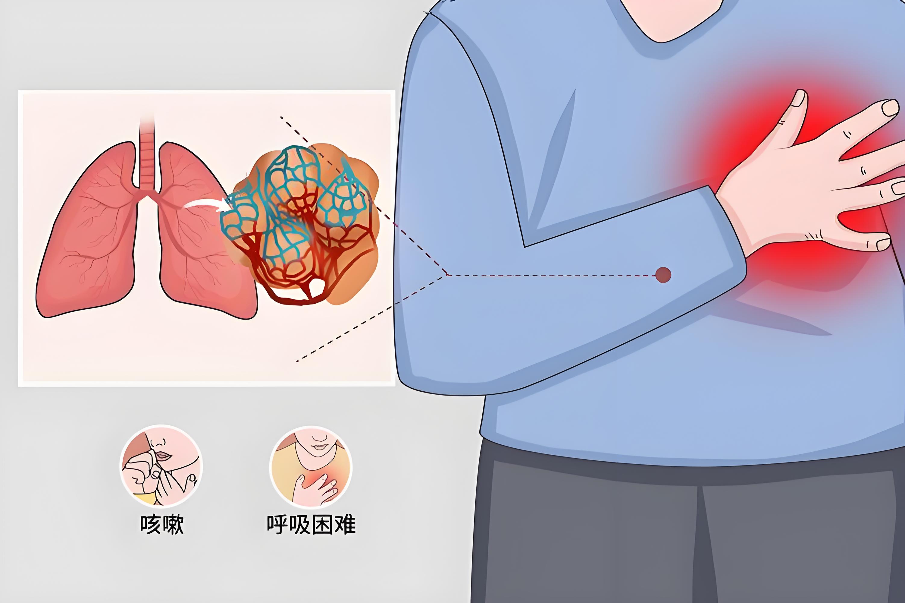 重磅积极信号，IPF有望进入吸入治疗时代！ “瑞思普利”自主研发的RSN0402吸入粉雾剂成功完成I期临床首例受试者入组