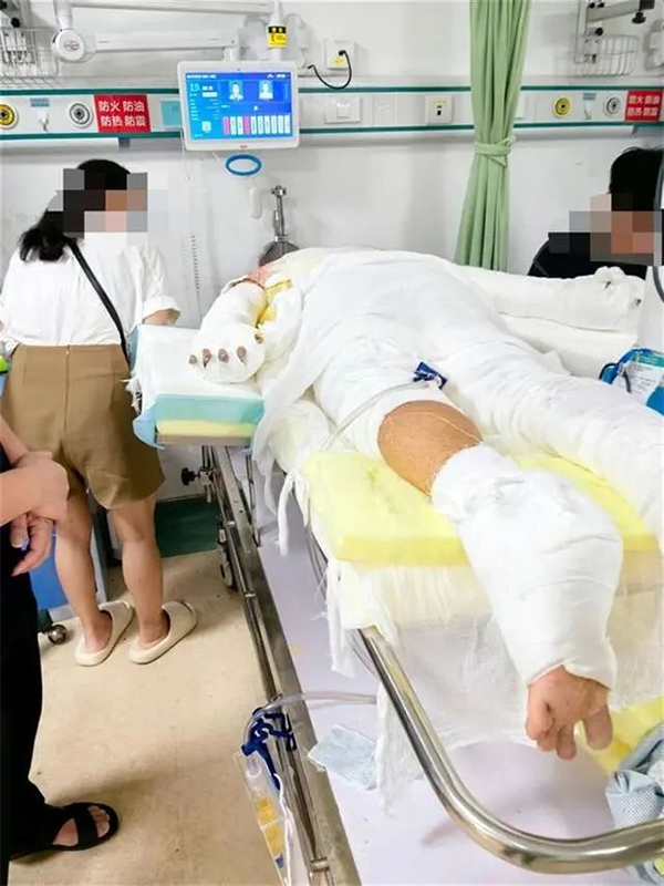 突发爆炸,大学生全身60%烧伤!又是因为…… 突发爆炸,大学生全身60%烧伤!又是因为……
