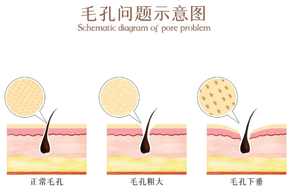 毛孔粗大怎么办？