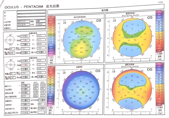 大众科普|一文带您了解全飞秒激光手术