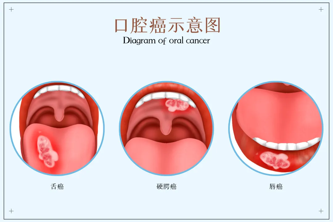 大众科普|可防可治的口腔癌，您了解多少？