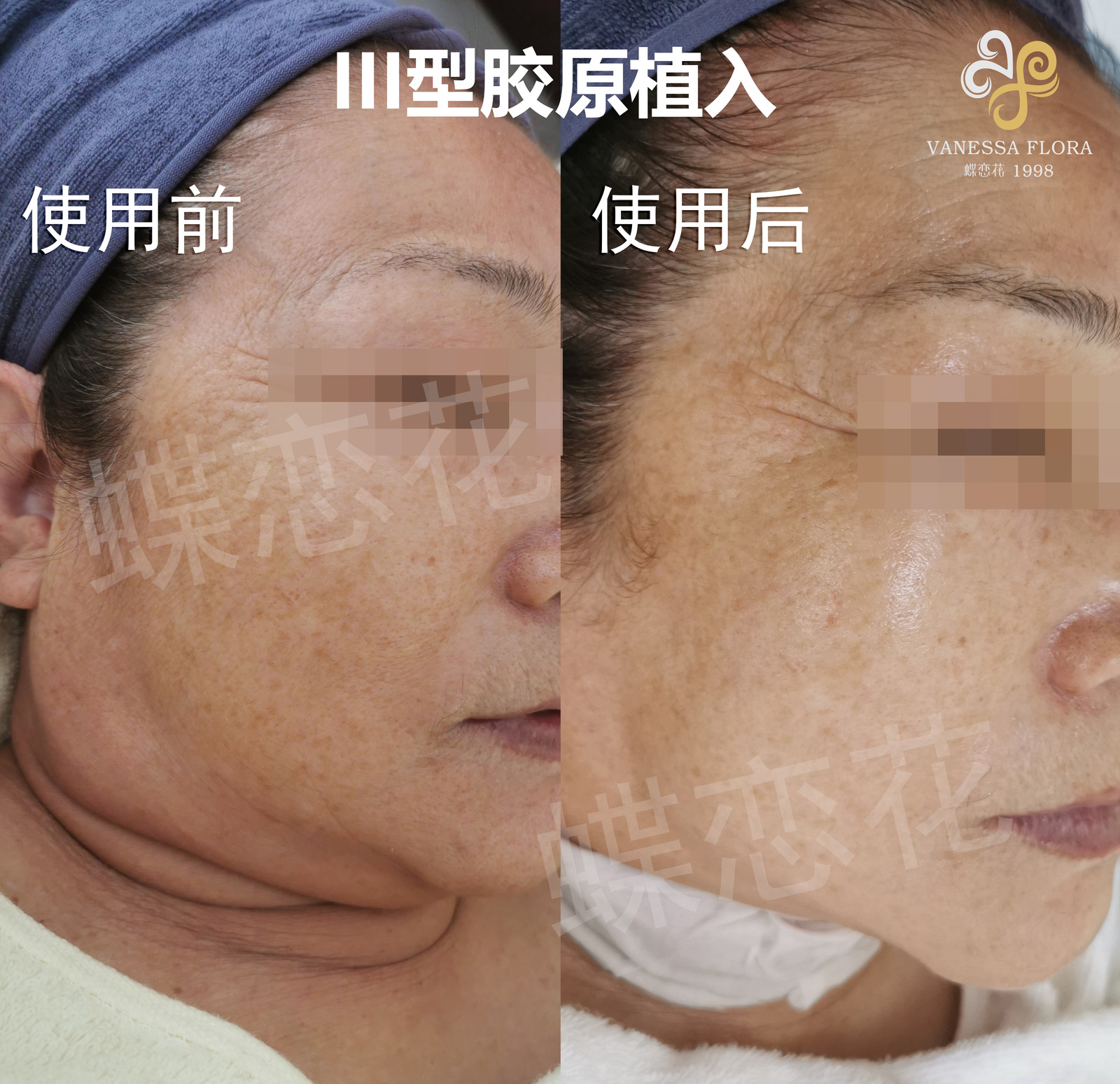 蝶恋花III型胶原采用原幼生植入项目<br> 以高含量=高效果=高满意度，重塑美容院服务新标杆
