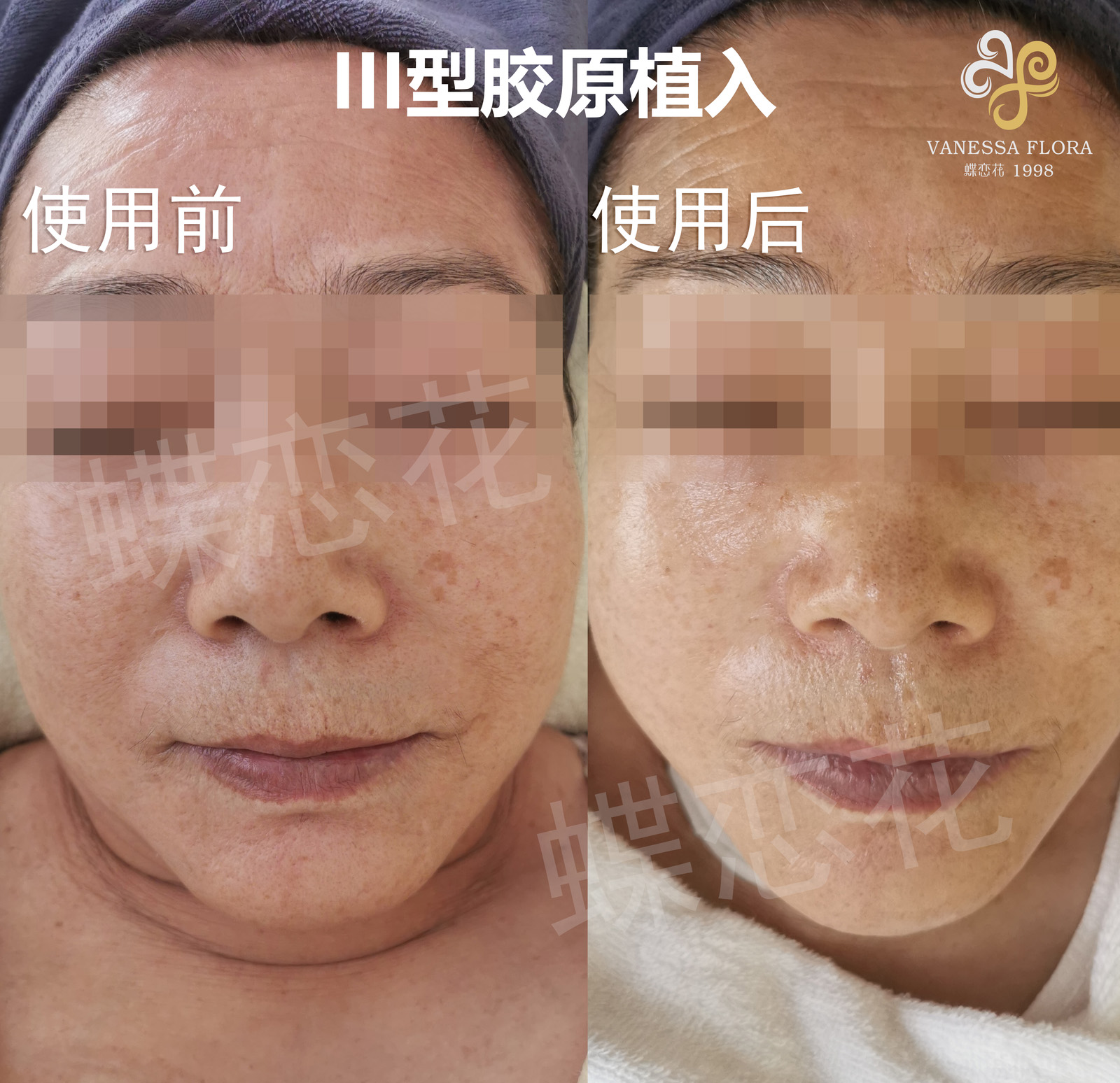 蝶恋花III型胶原采用原幼生植入项目<br> 以高含量=高效果=高满意度，重塑美容院服务新标杆