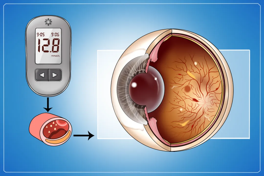 大众科普|别让糖尿病偷走光明，定期眼科检查很重要