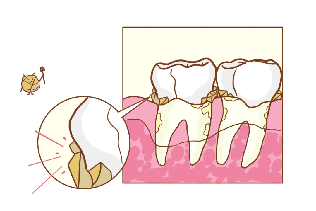 大众科普|明明天天刷牙，牙结石为何还“疯狂生长”