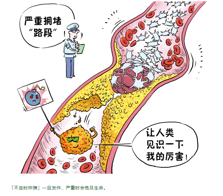 拆掉血管里的「违章建筑」——斑块