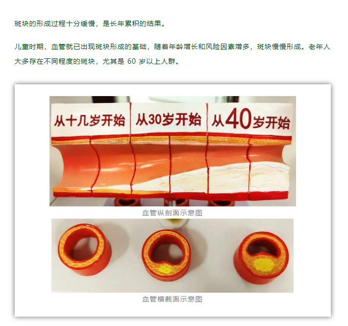 拆掉血管里的「违章建筑」——斑块