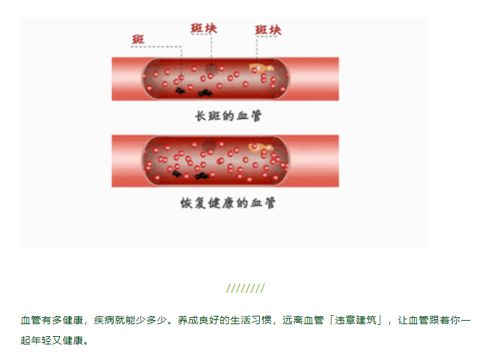 拆掉血管里的「违章建筑」——斑块
