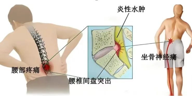 精微除顽疾 脊护健康行|金沙洲医院骨科微创UBE技术为腰椎间盘突出患者重启无痛人生 精微除顽疾 脊护健康行|金沙洲医院骨科微创UBE技术为腰椎间盘突出患者重启无痛人生