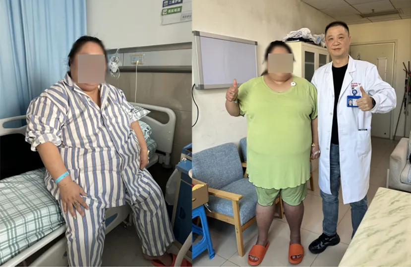 病例分享|肥胖与代谢病治疗中心|332 斤胖女孩的生死突围:从健康危机到新生蜕变 病例分享|肥胖与代谢病治疗中心|332 斤胖女孩的生死突围:从健康危机到新生蜕变