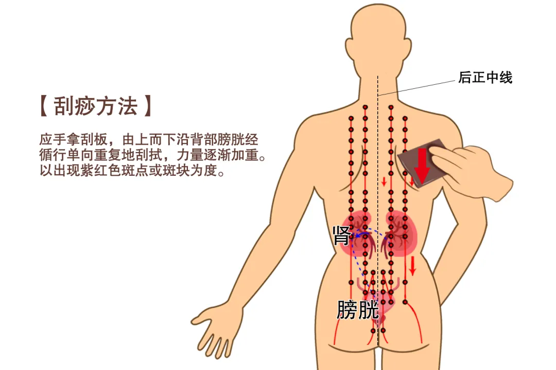 大众科普|中医经络刮痧:传统疗法的现代解读与临床应用 大众科普|中医经络刮痧:传统疗法的现代解读与临床应用