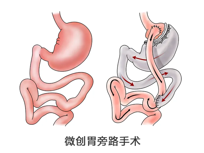 病例分享|16岁少年与糖尿病斗争和重获新生的故事 病例分享|16岁少年与糖尿病斗争和重获新生的故事