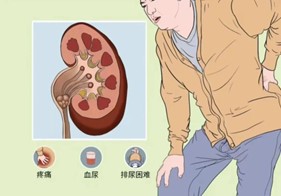肾结石与夏天 肾结石与夏天