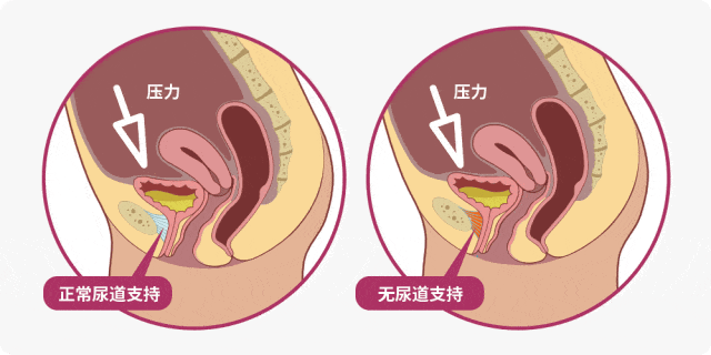 世界尿失禁周 | 守护盆底健康,远离“湿”意人生! 世界尿失禁周 | 守护盆底健康,远离“湿”意人生!