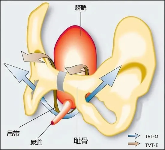 世界尿失禁周 | 守护盆底健康,远离“湿”意人生! 世界尿失禁周 | 守护盆底健康,远离“湿”意人生!