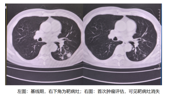 复融生物FL115治疗晚期实体瘤再显奇效，靶病灶获完全消除（CR）| 项目进展